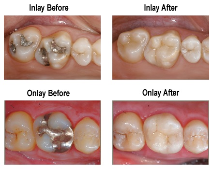 Cerec - Before and After photos